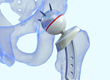CAD - Bone implant